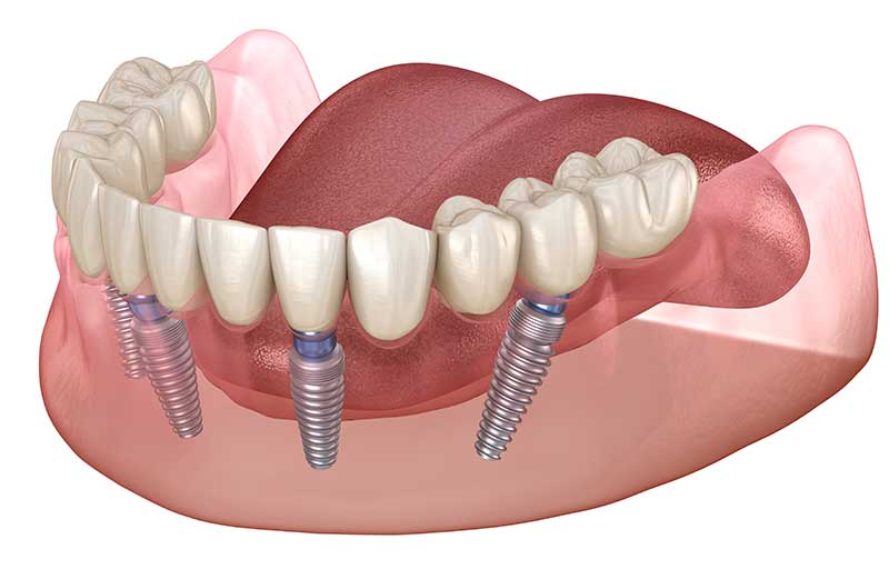 Innovations in Full Arch Dental Solutions